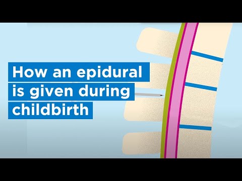 Video: How Epidurals Are Given