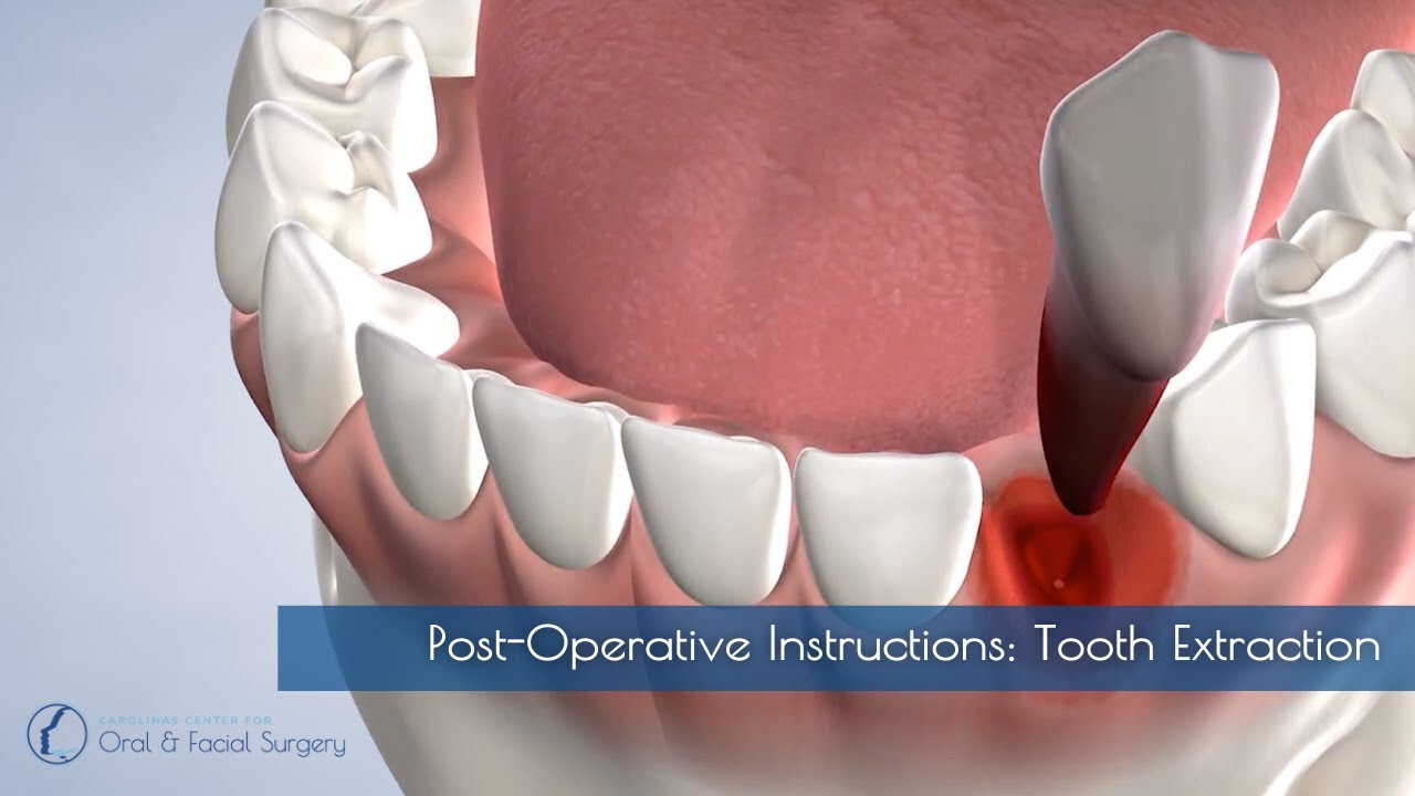 Post Operative Instructions Tooth Extraction YouTube Post Operative Instructions Tooth Extraction YouTube