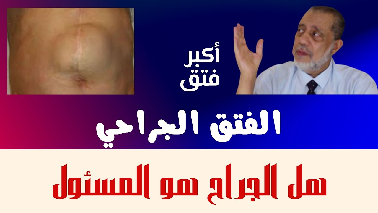 الفتق الجراحي/أكبر فتق ممكن تشوفه/هل الجراح هو المسئول عن حصول الفتق بعد العملية/كيف الوقاية