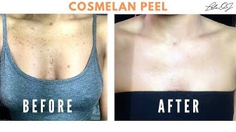 How to get rid of dark spots: My Cosmelan peel experience How to get rid of dark spots: My Cosmelan peel experience