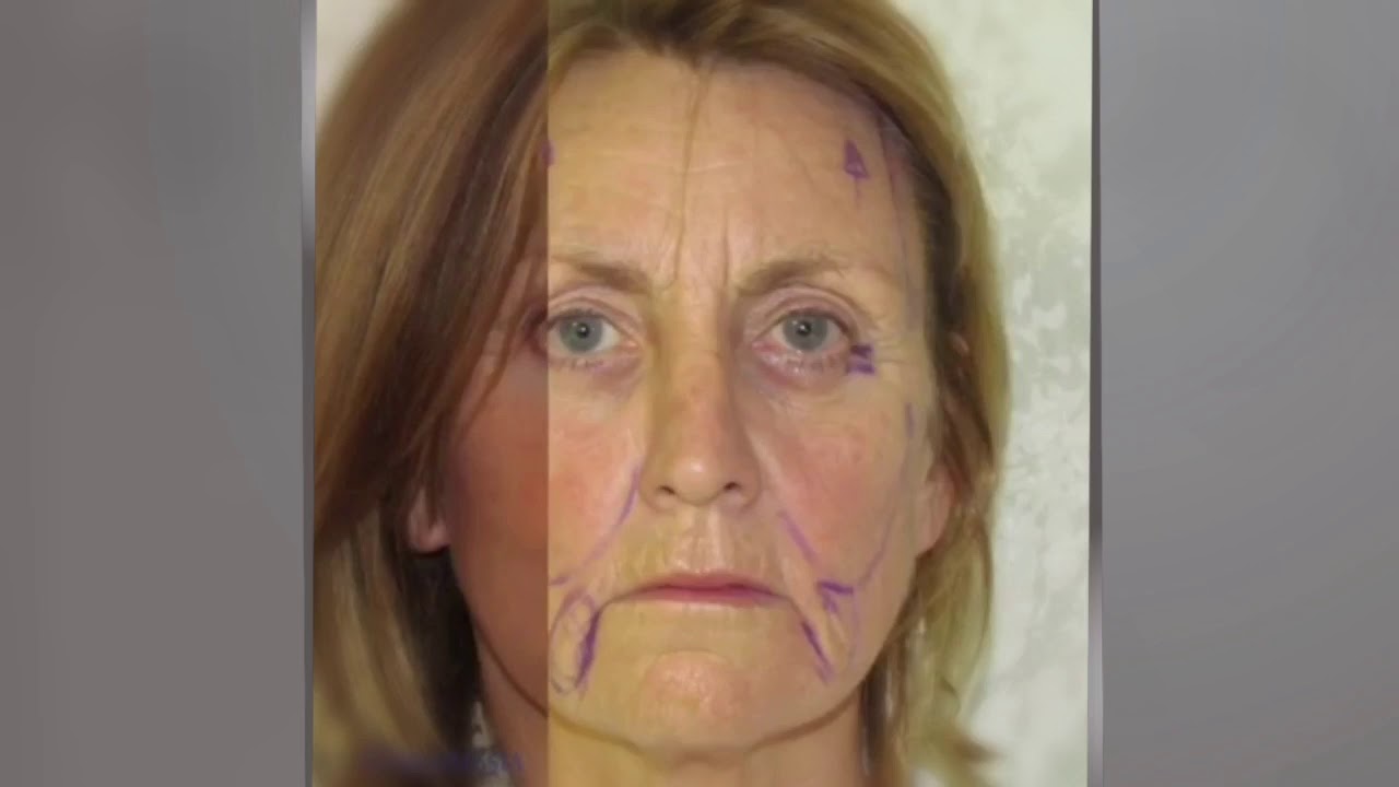 Face lift YouTube