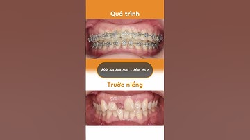 Hành trình LỘT XÁC nhờ niềng răng của Lan Anh