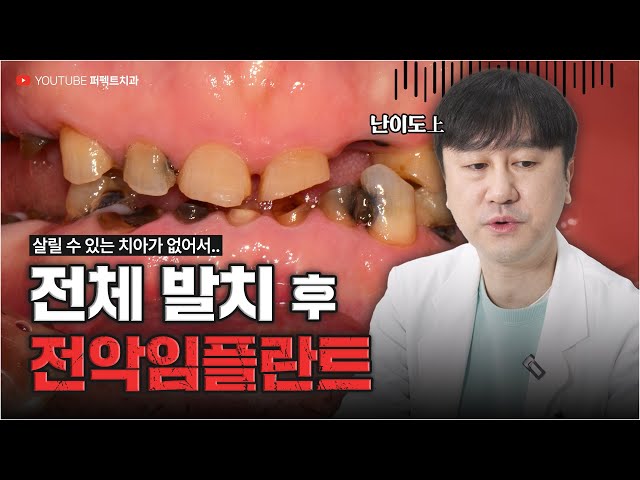 살릴 치아가 없어 전체발치❓ 전악임플란트로 해결👍 (feat.임시치아,임시틀니)