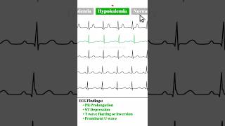 ECG Rhythm comparison (Hyperkalemia, Hypokalemia, Hypercalcaemia, Hypocalcaemia) #ecg #cardiology