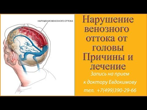 Нарушение венозного оттока головного мозга по позвоночным венам  Причины нарушения венозного оттока