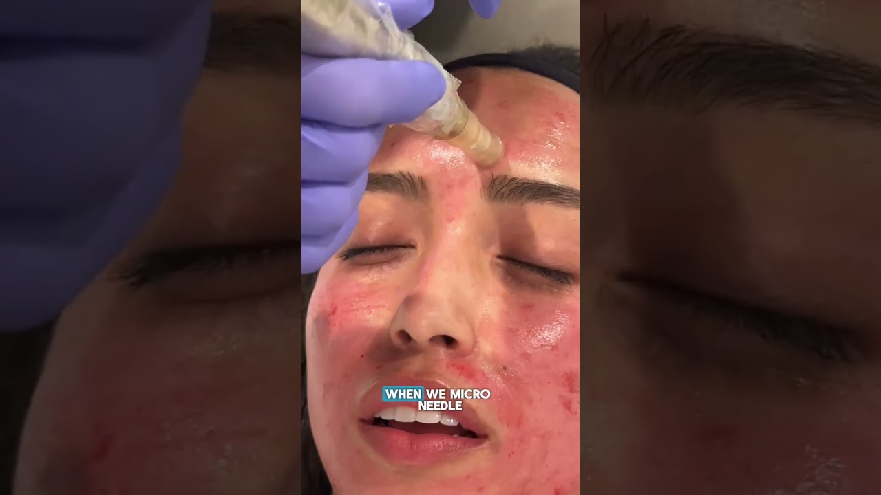 Microneedling Pens - Eclipse - Amiea Med - Collagen P.I.N.