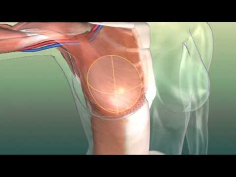 Video: Modifizierte Radikale Mastektomie: Verfahren Und Wiederherstellung