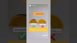 تطبيق الديرمابن على البشرة dermapen effects on skin absorption #rejuvenation #dermapen #skin #بشرة