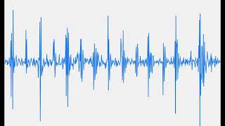 Irregular heartbeat