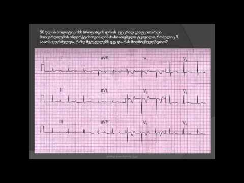 პირველი ხარისხის ატრიოვენტრიკულური ბლოკადა, მიოკარდიუმის ინფარქტი (ფილტვის არტერიის თრომბოემბოლია)