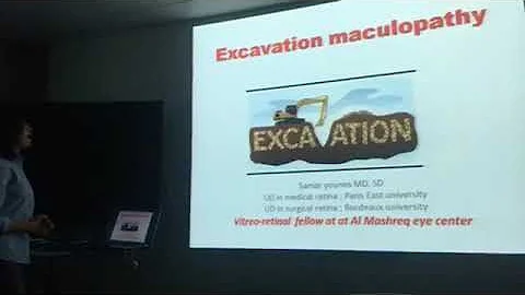 Excavation maculopathy.dr.s...  younes