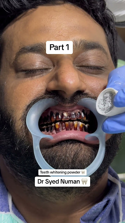 Teeth whitening powder #dentistteeth #teethwhiteningproducts #doctor #toothdental #teethwhitening #