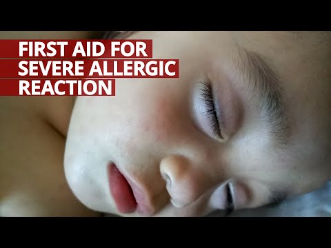 Video: Paano Protektahan ang Mga Bata na may Mga Allergies sa Pagkain (na may Mga Larawan)