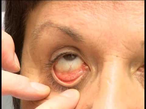 Video: Mělo by se růžové oko léčit antibiotiky?