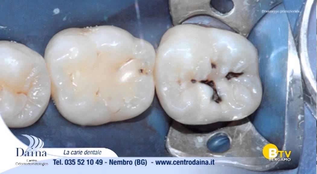 Rubrica Odonto Salute - 3ª Ed. - 4ª Puntata: LA CARIE DENTALE: COME PREVENIRLA E CURARLA