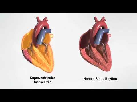 supraventricular tachycardia - YouTube