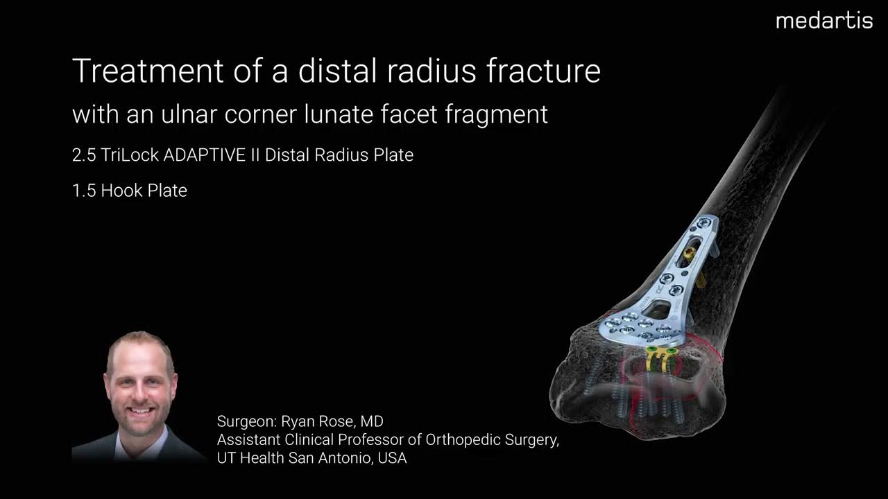 Treatment of a distal radius fracture with an ulnar corner lunate facet fragment YouTube