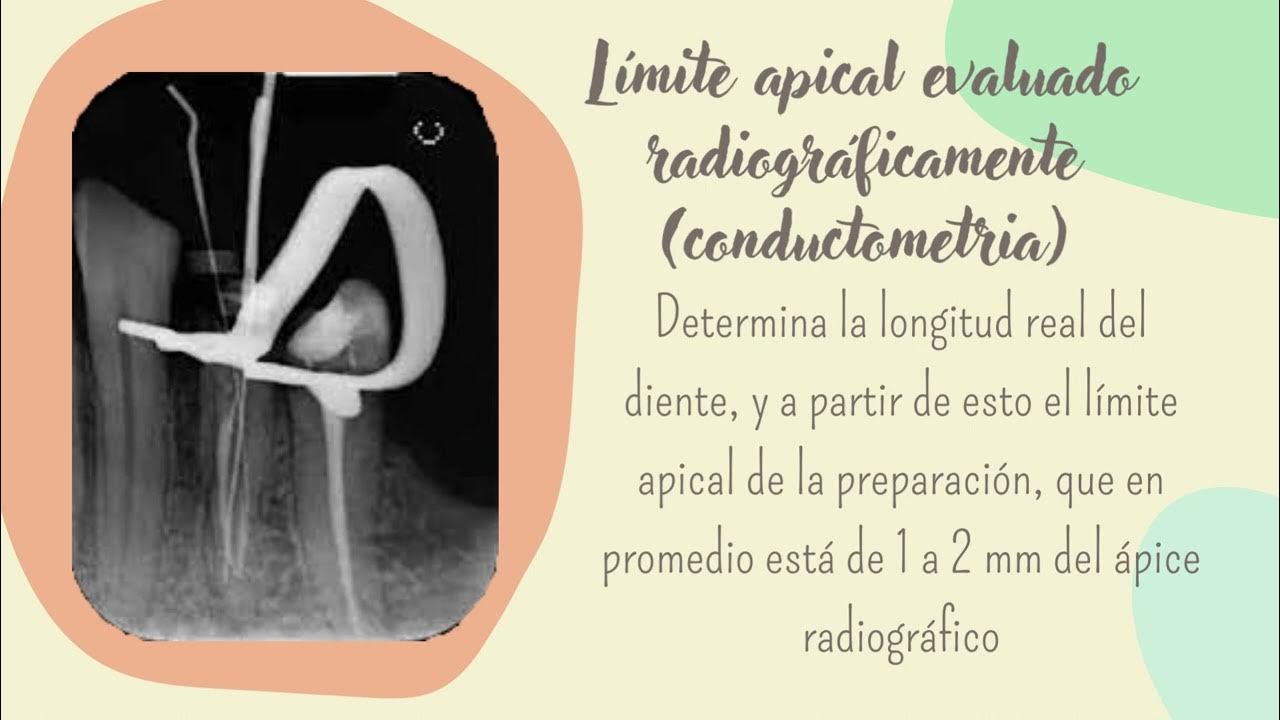 LÍMITE APICAL DE LA PREPARACIÓN ENDODÓNTICA YouTube