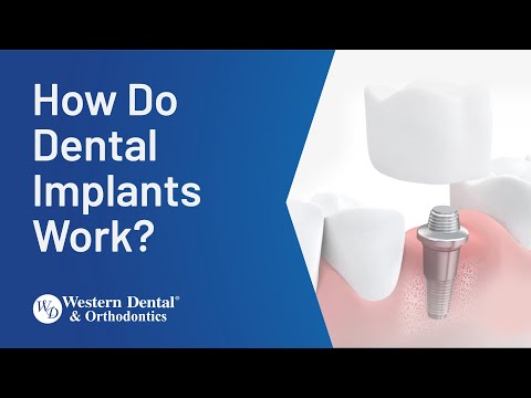 How Dental Implants Work? (4 Steps) | Western Dental