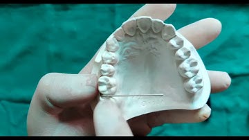 Dr Piyush Khandelwal- Making of C Clasp