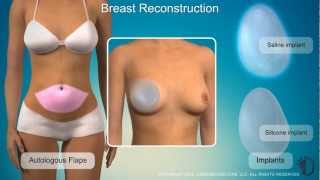 What is Breast Reconstruction? (Breast Cancer) by Understand 361,685 views 11 years ago 12 minutes, 3 seconds