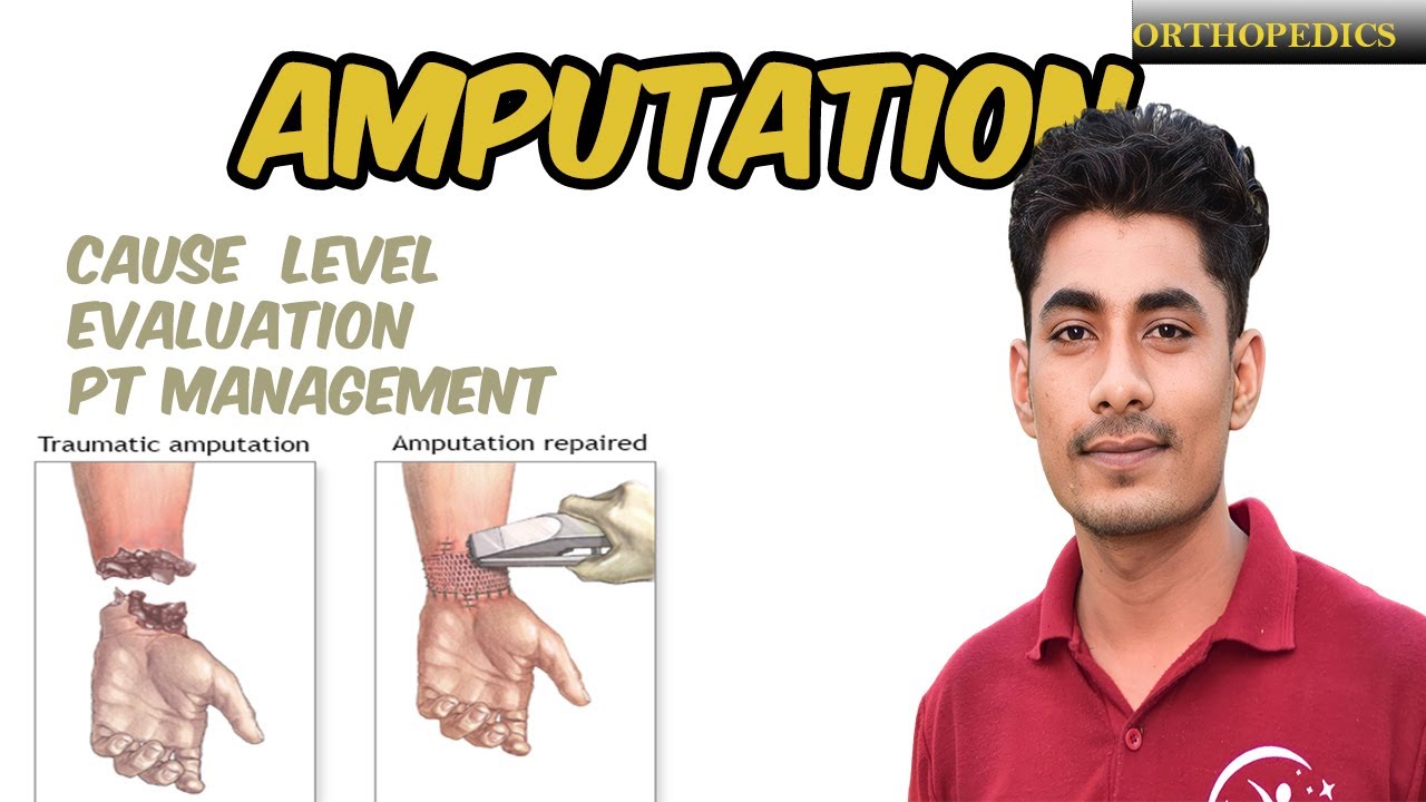 AMPUTATION | CAUSES | LEVEL OF AMPUTATION | EVALUATION | PT MANAGEMENT