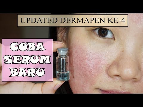 Menghilangkan Bopeng Dengan Dermapen & Coba Serum untuk Acne Scar