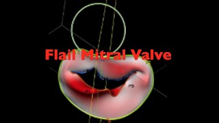 Flail Mitral Valve: 2D 3D TEE TrueVue & GlassVue