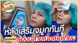 รีวิวหลังเสริมจมูกคุณชะเอมเสริมจมูกทรงสโลปปลายพุ่ง+รองปลายเนื้อเยื่อเทียมหลังIศัลย์มันเป็นงี้! EP.1