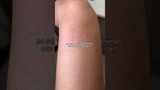 Rasierpickel zu glatten Beinen #skincare #rasur