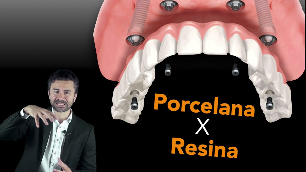 Implante Dentário Porcelana ou Resina?