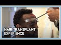 Hair Transplant Experience: Afro-American Guest from Los Angeles