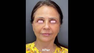 Face/Neck Lift &amp; Fat Grafting.