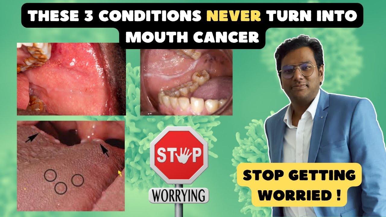 Mohan3 Dr Rudra Mohan | 3 oral conditions that can NEVER turn into ORAL CANCER ...