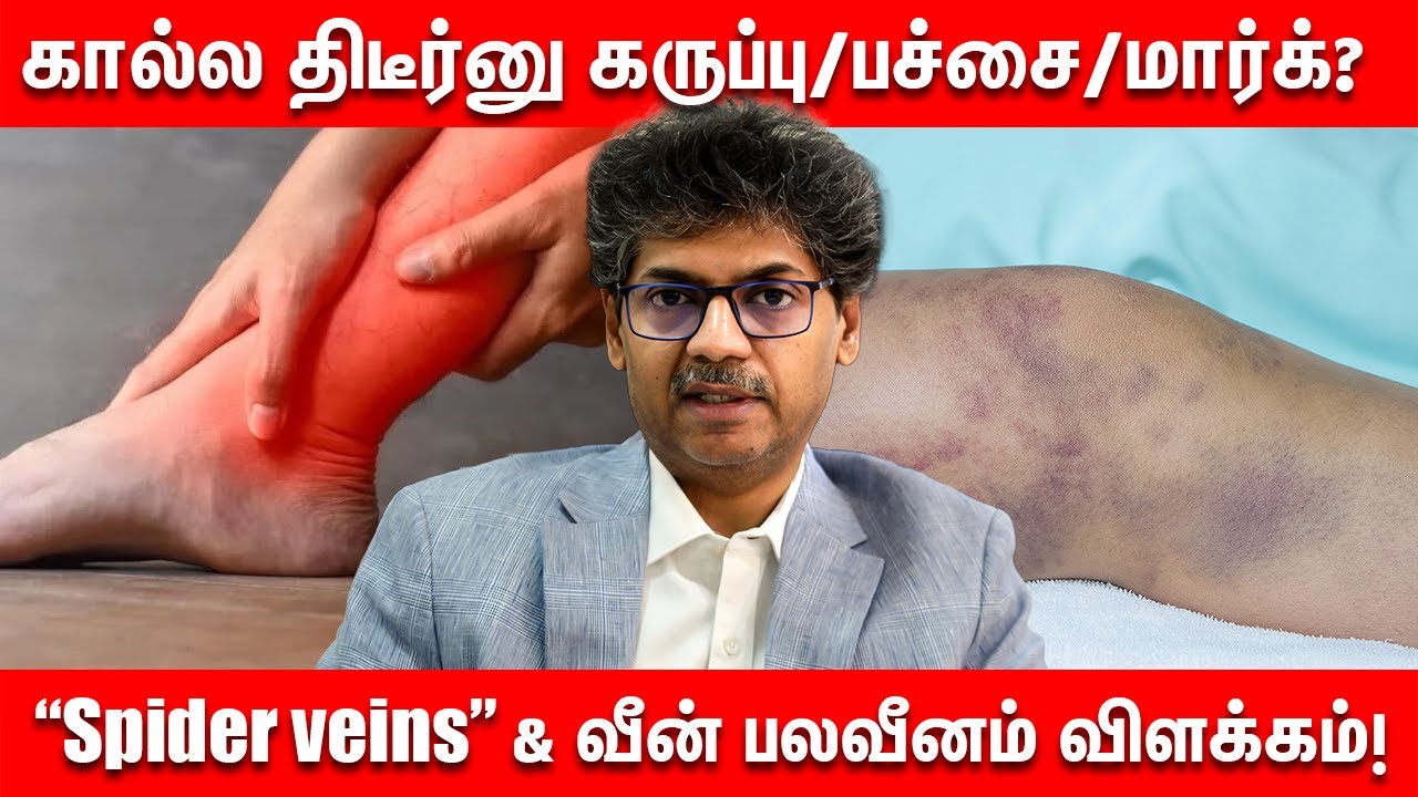 கால்ல திடீர்னு கருப்பு பாச்/மார்க்? “Spider veins” & வீன் பலவீனம் விளக்கம்! | DR Balakumar