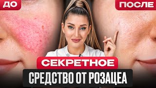 Покраснения уйдут навсегда! / Как БЫСТРО и БЕЗ боли избавиться от розацеа?
