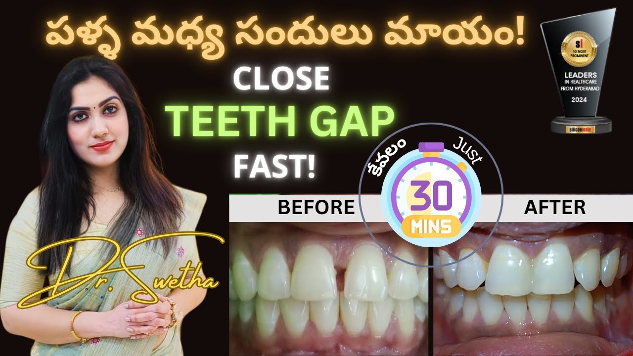 Teeth Gap Treatment | Midline Diastema Fix | పళ్ల మధ్య గ్యాప్ ఎలా క్లోజ్ చేయాలి? | Hyderabad Dentist