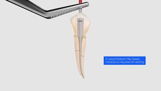 Carrier‑Based Technique with AH Plus® Ribbon Endodontic Sealer and GuttaCore® Obturators