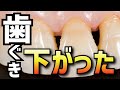 【薬不使用】歯ぐき下がりの原因と下がった歯ぐきを元に戻す自然な方法