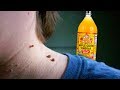 She Had An Ugly Skin Tag On Her Neck And This Is How She Removed It