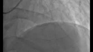 Cardio2012-Ecg331 006 Lca Rao2 Cran26 Wire