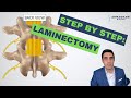 Step by step how to perform a lumbar laminectomy