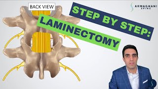 Step by step how to perform a lumbar laminectomy