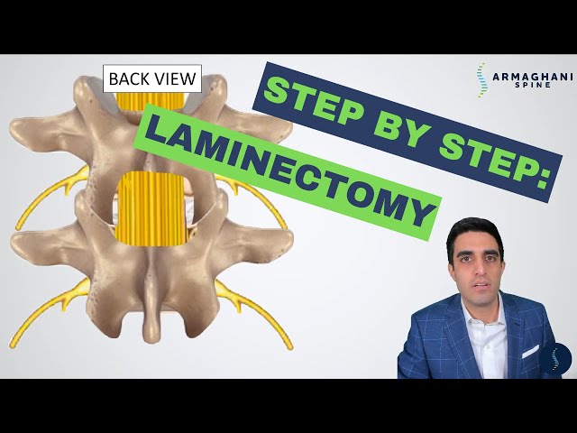 Step by step how to perform a lumbar laminectomy class=