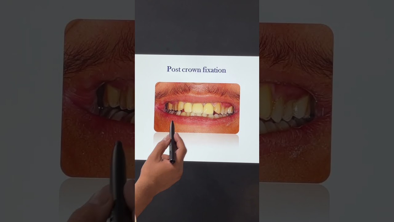 Dental Implants Procedure | Dental Implant cost in India #bestdentistdelhi #dentistdelhi