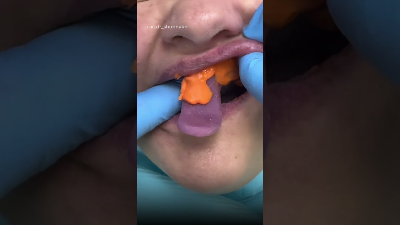 На чем держаться протезы?