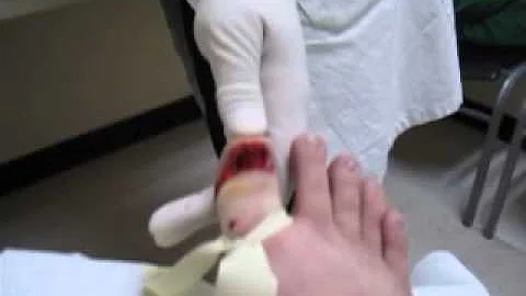 gnarly ingrown toe nail removal