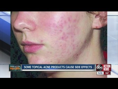 Some acne treatments cause side effects