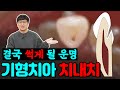 치아 속에 또 치아가 있다?! | 결국 썩게 될  슬픈 운명의 치아를 공개합니다|