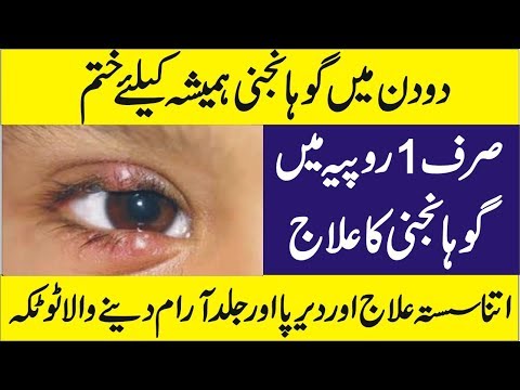 gohanjni treatment in 1 day, how to get rid of stye, gohanjni ka ilaj in...